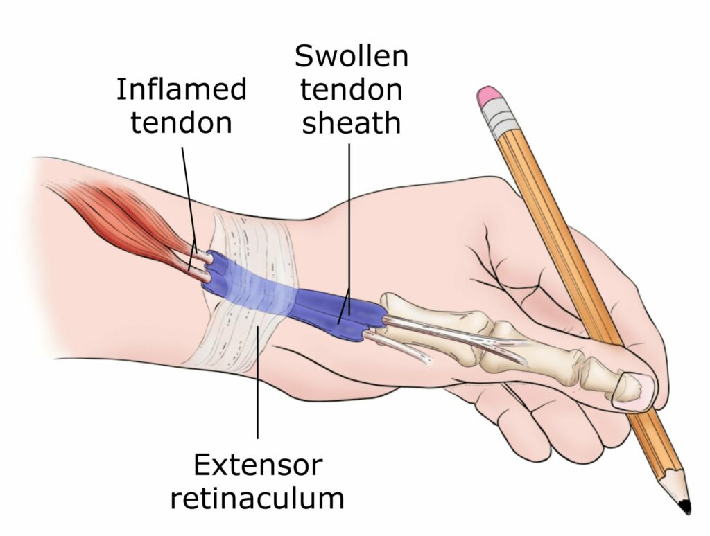 Wrist and thumb pain